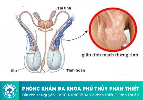 Sưng vùng bìu nguyên nhân do đâu?