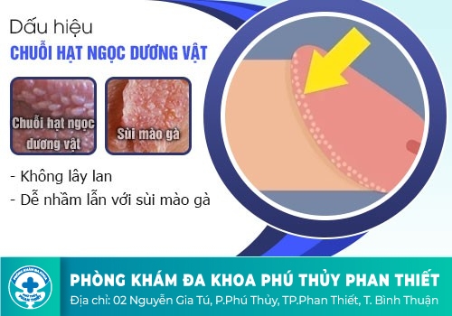 Hình ảnh chuỗi hạt ngọc dương vật ở nam giới