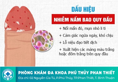Nấm bao quy đầu