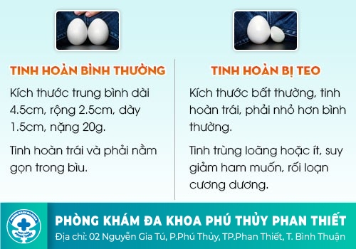 Làm sao nhận biết tinh hoàn bị teo