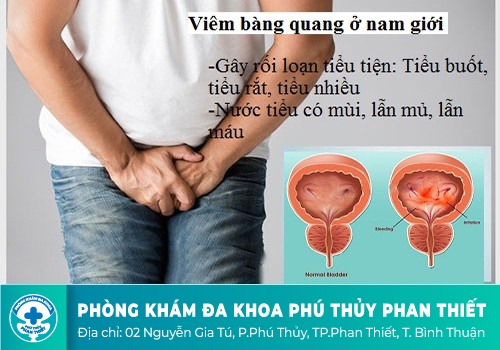Đau bàng quang do bị viêm bàng quang 