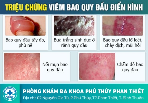 Buốt dương vật, buốt đầu dương vật là bệnh gì?