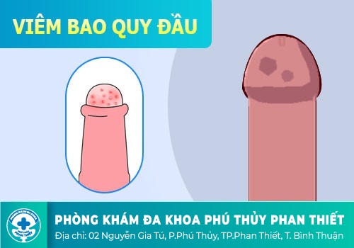 TỰ CHỮA VIÊM BAO QUY ĐẦU CÓ ĐƯỢC KHÔNG?