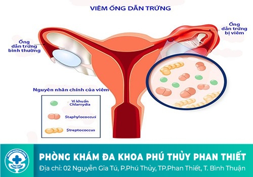 Đau bụng dưới ở nữ giới