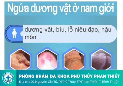 Cách Trị Ngứa Dương Vật Hiệu Quả Hiện Nay