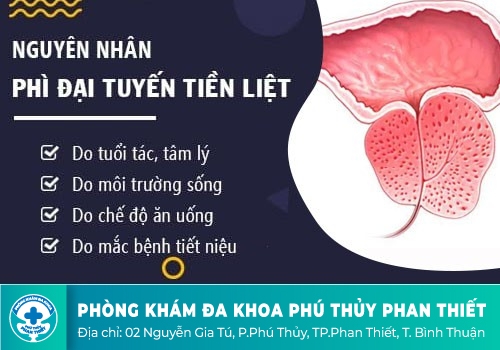 Phì đại tuyến tiền liệt