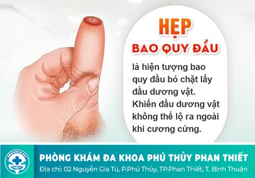 Hẹp bao quy đầu là gì?