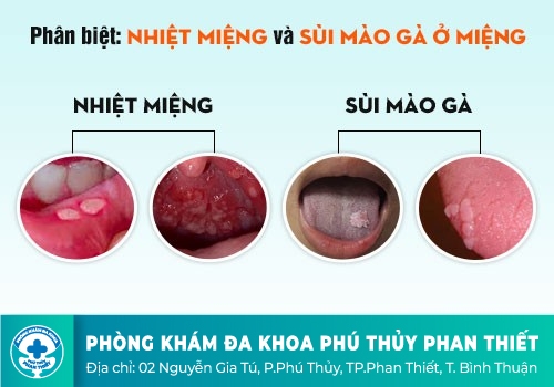 NHẬN BIẾT NHỮNG TRIỆU CHỨNG SÙI MÀO GÀ Ở HỌNG