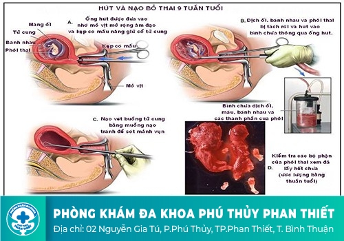 Nạo hút thai có đau không