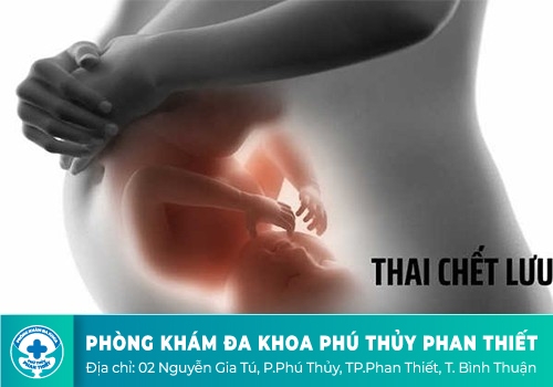 Thai chết lưu 