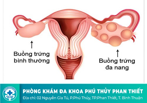 Hội chứng buồng trứng đa nang