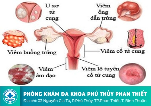 VIÊM NHIỄM PHỤ KHOA 
