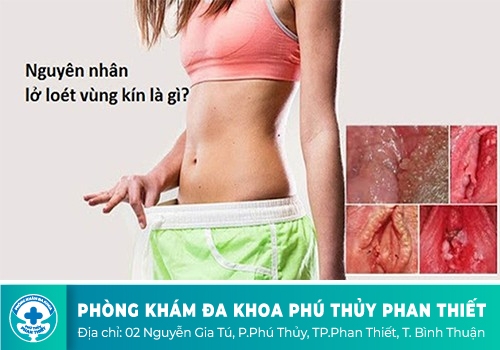 dấu hiệu lở loét âm đạo