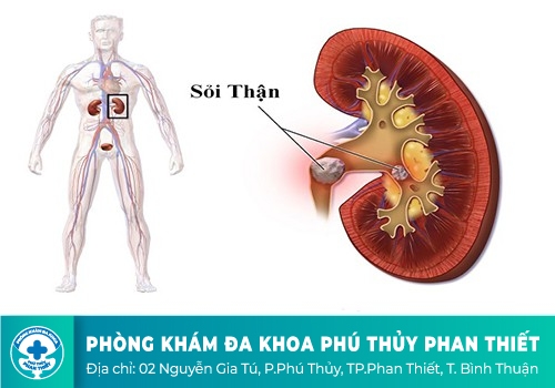  Sỏi thận
