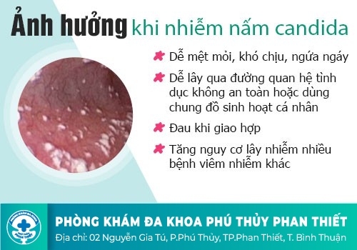  viêm nấm Candida