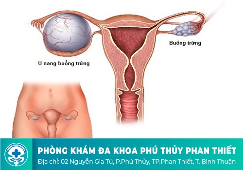  U nang buồng trứng