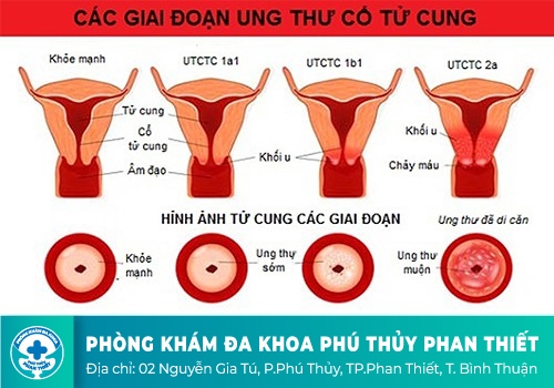 Ung thư cổ tử cung