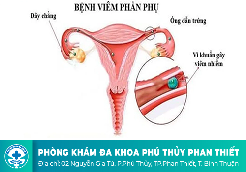 Viêm phần phụ