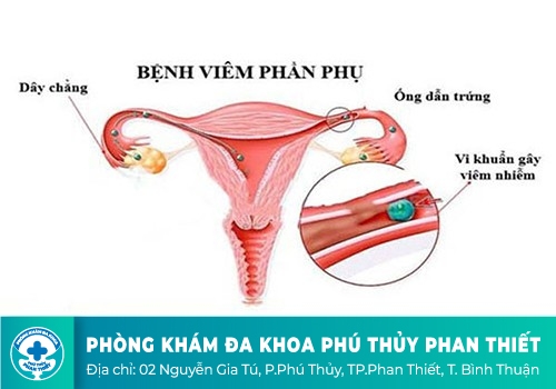 viêm phần phụ