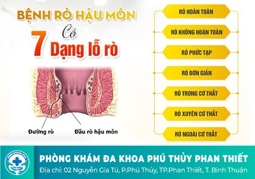 NHỮNG DẠNG RÒ HẬU MÔN NÊN BIẾT