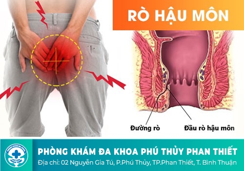 NHỮNG DẠNG RÒ HẬU MÔN NÊN BIẾT