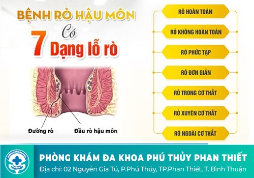 Vì sao cần chữa rò hậu môn càng sớm càng tốt?