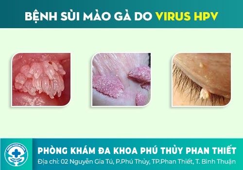 Hình ảnh bệnh sùi mào gà