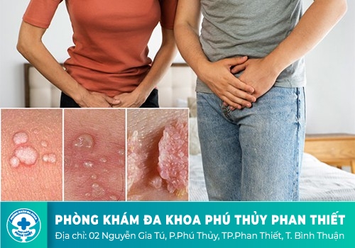 Triệu chứng sùi mào gà ở nữ giới là gì?