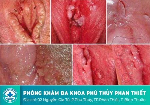 Xét nghiệm sùi mào gà bao nhiêu tiền