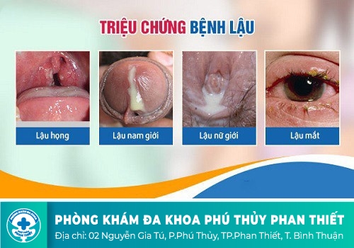 Bệnh lậu