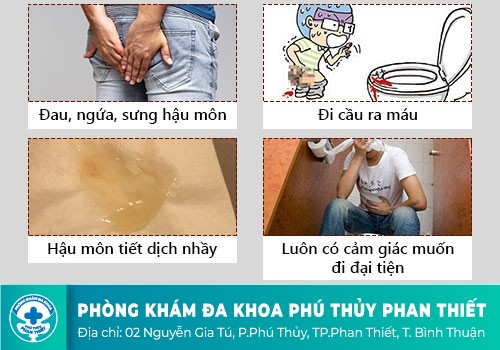 NHỮNG BIỂU HIỆN BỆNH TRĨ NGOẠI?