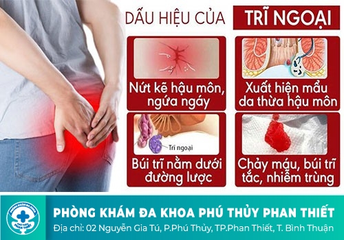Cách nhận biết sớm dấu hiệu bệnh trĩ ngoại