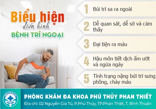 Nhận biết triệu chứng của bệnh trĩ ngoại qua từng cấp độ
