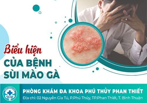Dấu hiệu nhận biết sùi mào gà sinh dục