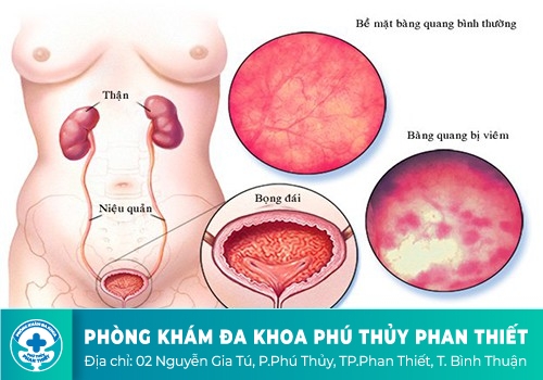 Tác hại của bệnh viêm bàng quang đến sức khỏe người bệnh