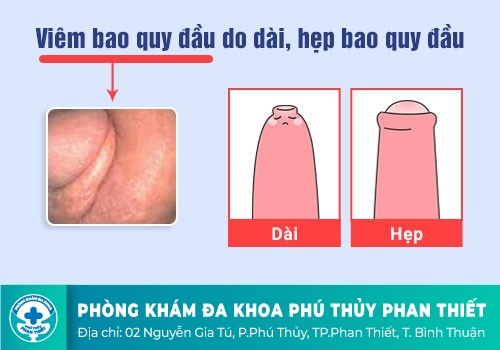 Nguyên nhân gì khiến bạn bị hẹp bao qui đầu