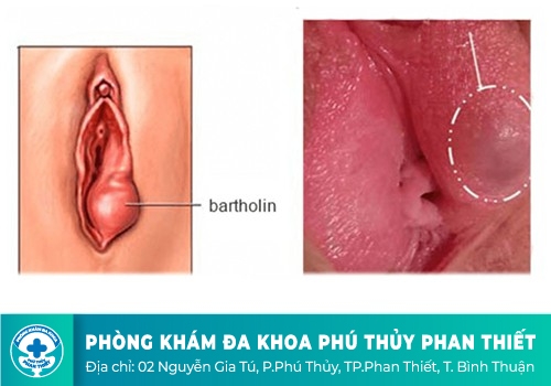 Viêm tuyến Bartholin là gì?