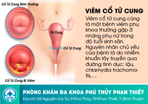Triệu chứng nhận biết viêm cổ tử cung các chị em nên biết