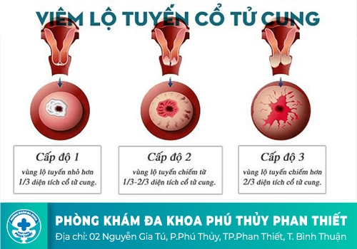 Viêm lộ tuyến cổ tử cung